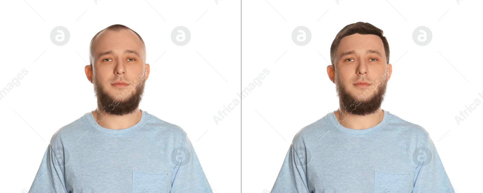 Baldness. Man before and after wearing wig or hair treatment on white background Image of Baldness. Man before and after wearing wig or hair treatment on white background