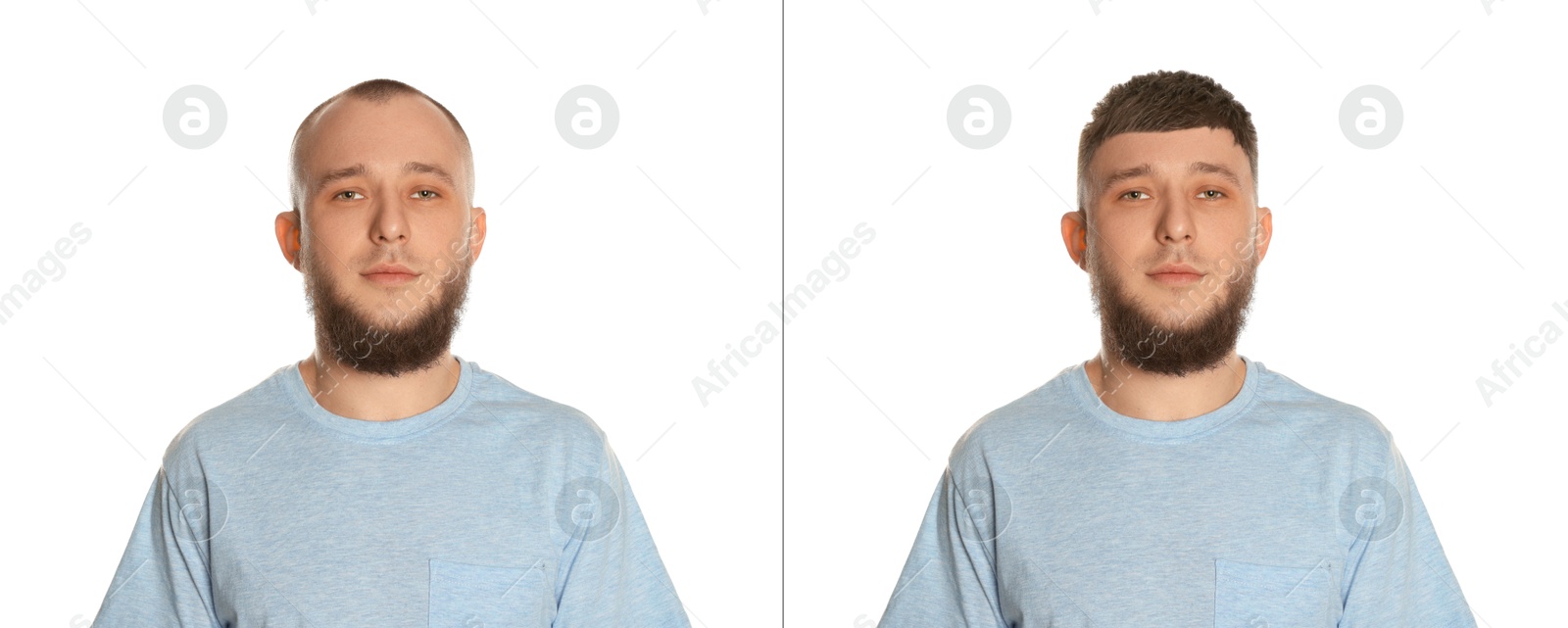 Baldness. Man before and after wearing wig or hair treatment on white background Image of Baldness. Man before and after wearing wig or hair treatment on white background