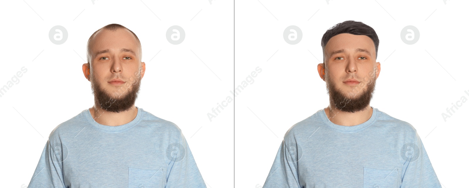 Baldness. Man before and after wearing wig or hair treatment on white background Image of Baldness. Man before and after wearing wig or hair treatment on white background