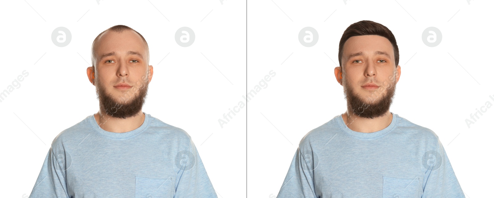Baldness. Man before and after wearing wig or hair treatment on white background Image of Baldness. Man before and after wearing wig or hair treatment on white background