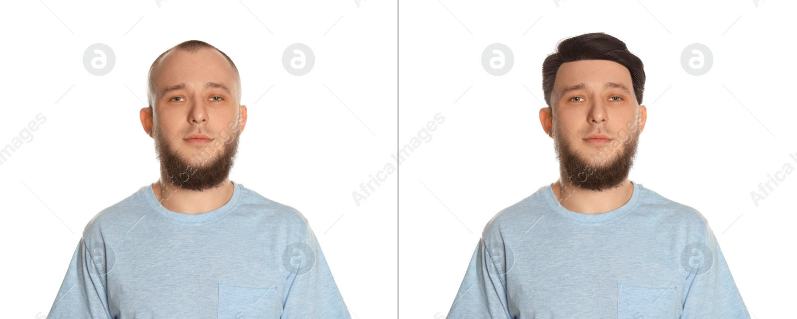 Baldness. Man before and after wearing wig or hair treatment on white background Image of Baldness. Man before and after wearing wig or hair treatment on white background