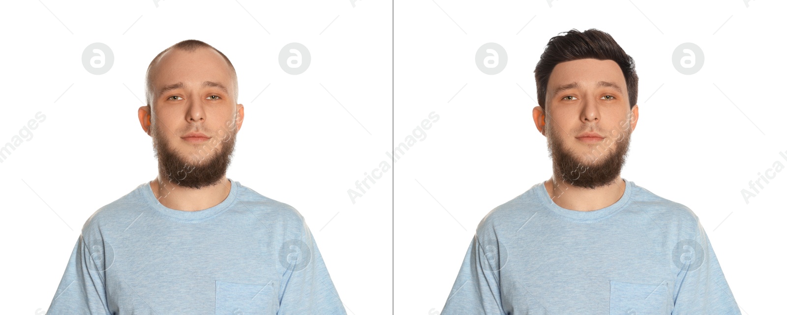 Baldness. Man before and after wearing wig or hair treatment on white background Image of Baldness. Man before and after wearing wig or hair treatment on white background
