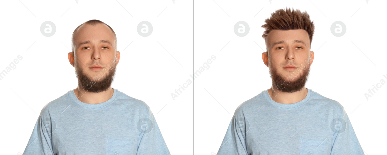 Baldness. Man before and after wearing wig or hair treatment on white background Image of Baldness. Man before and after wearing wig or hair treatment on white background