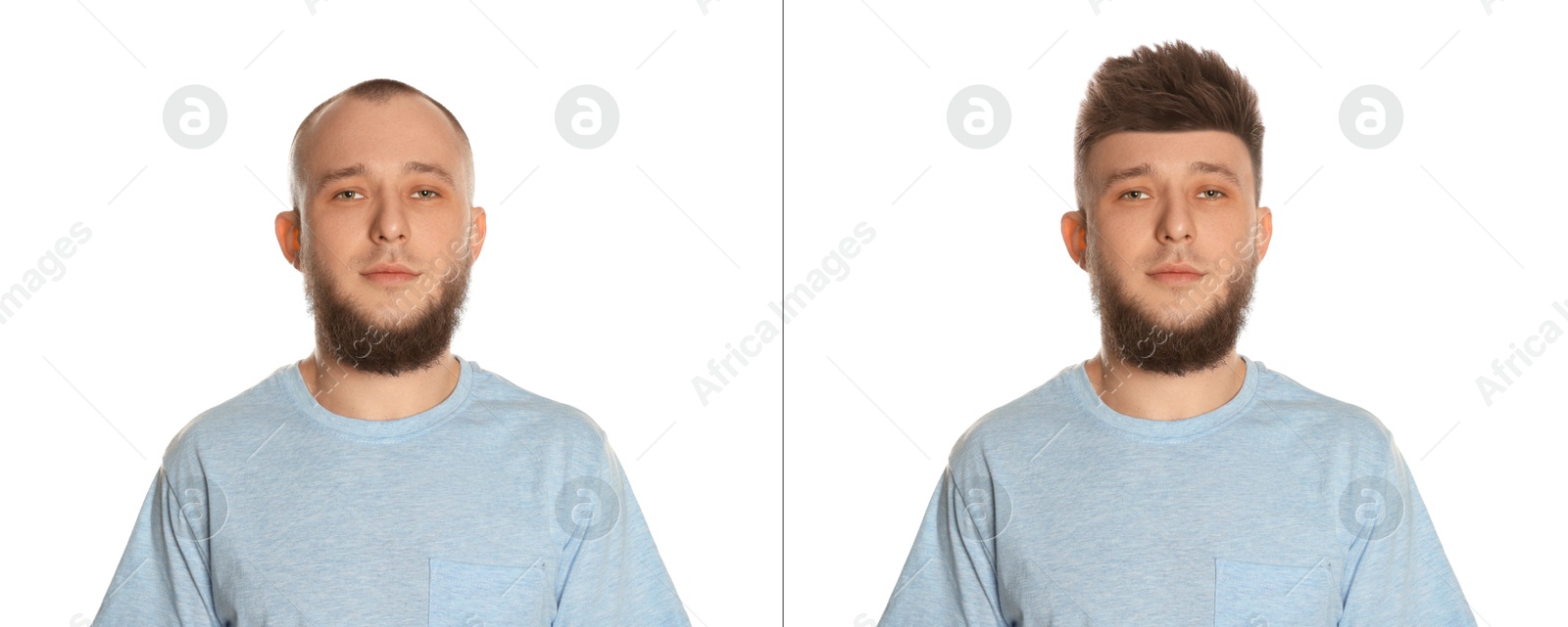 Baldness. Man before and after wearing wig or hair treatment on white background Image of Baldness. Man before and after wearing wig or hair treatment on white background