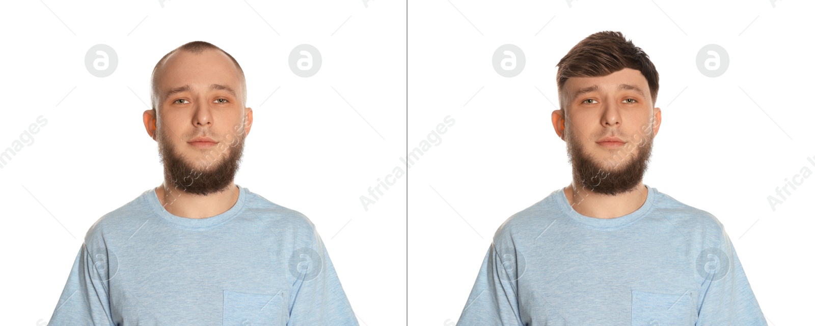 Baldness. Man before and after wearing wig or hair treatment on white background Image of Baldness. Man before and after wearing wig or hair treatment on white background