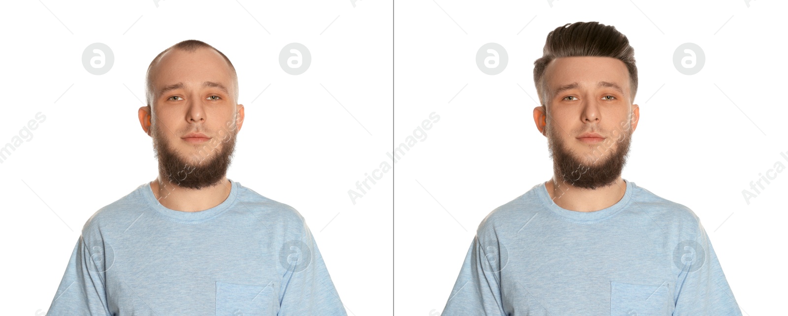 Baldness. Man before and after wearing wig or hair treatment on white background Image of Baldness. Man before and after wearing wig or hair treatment on white background