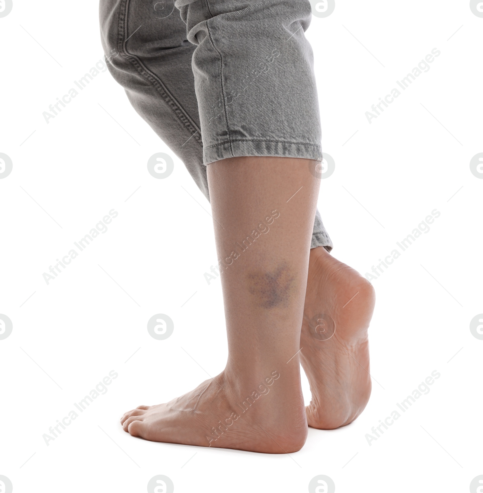 Woman with bruise on leg against white background, closeup Photo of Woman with bruise on leg against white background, closeup