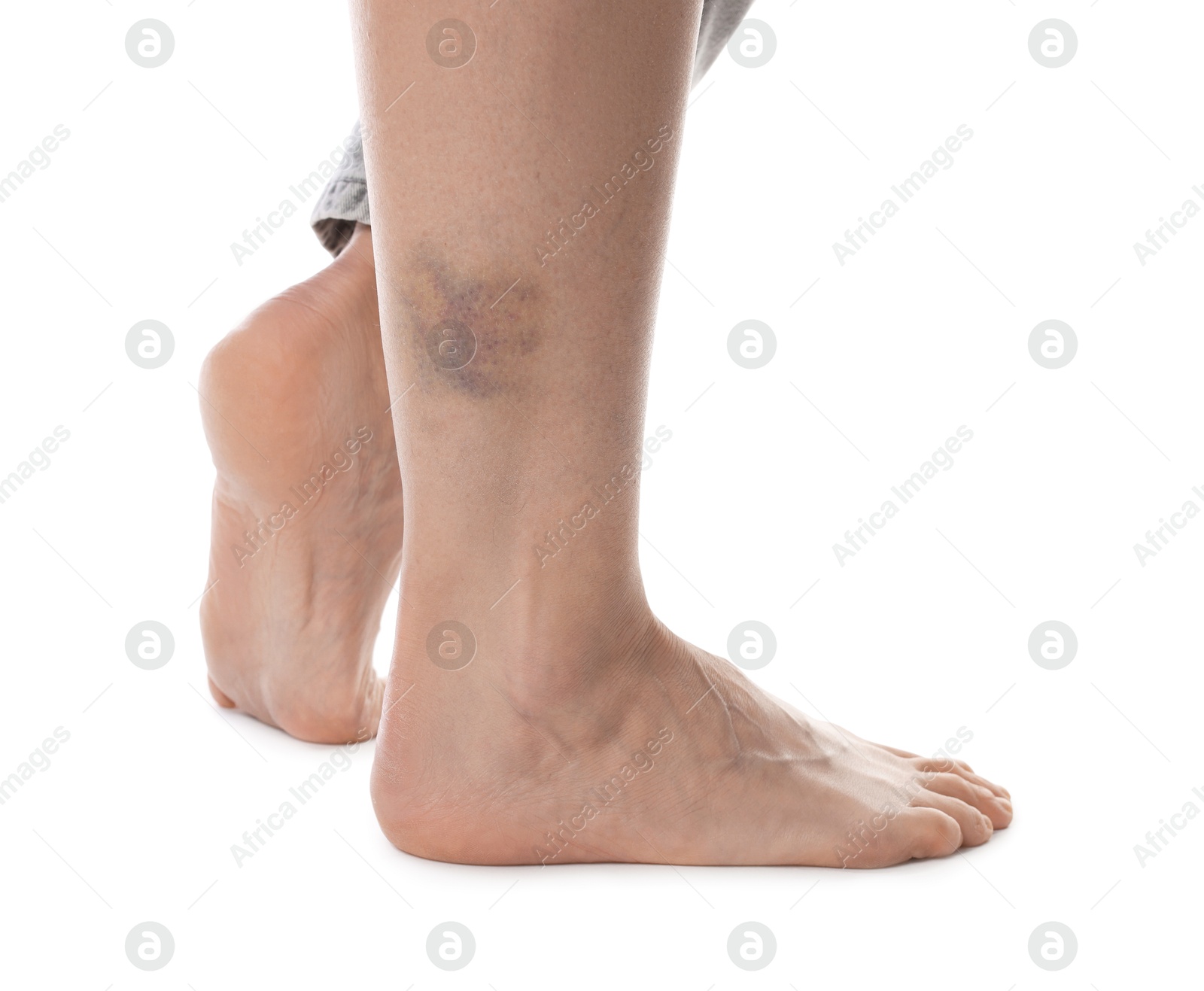 Woman with bruise on leg against white background, closeup Photo of Woman with bruise on leg against white background, closeup