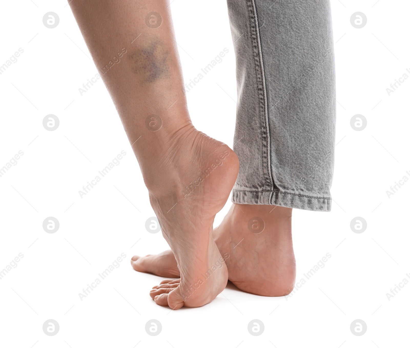 Woman with bruise on leg against white background, closeup Photo of Woman with bruise on leg against white background, closeup