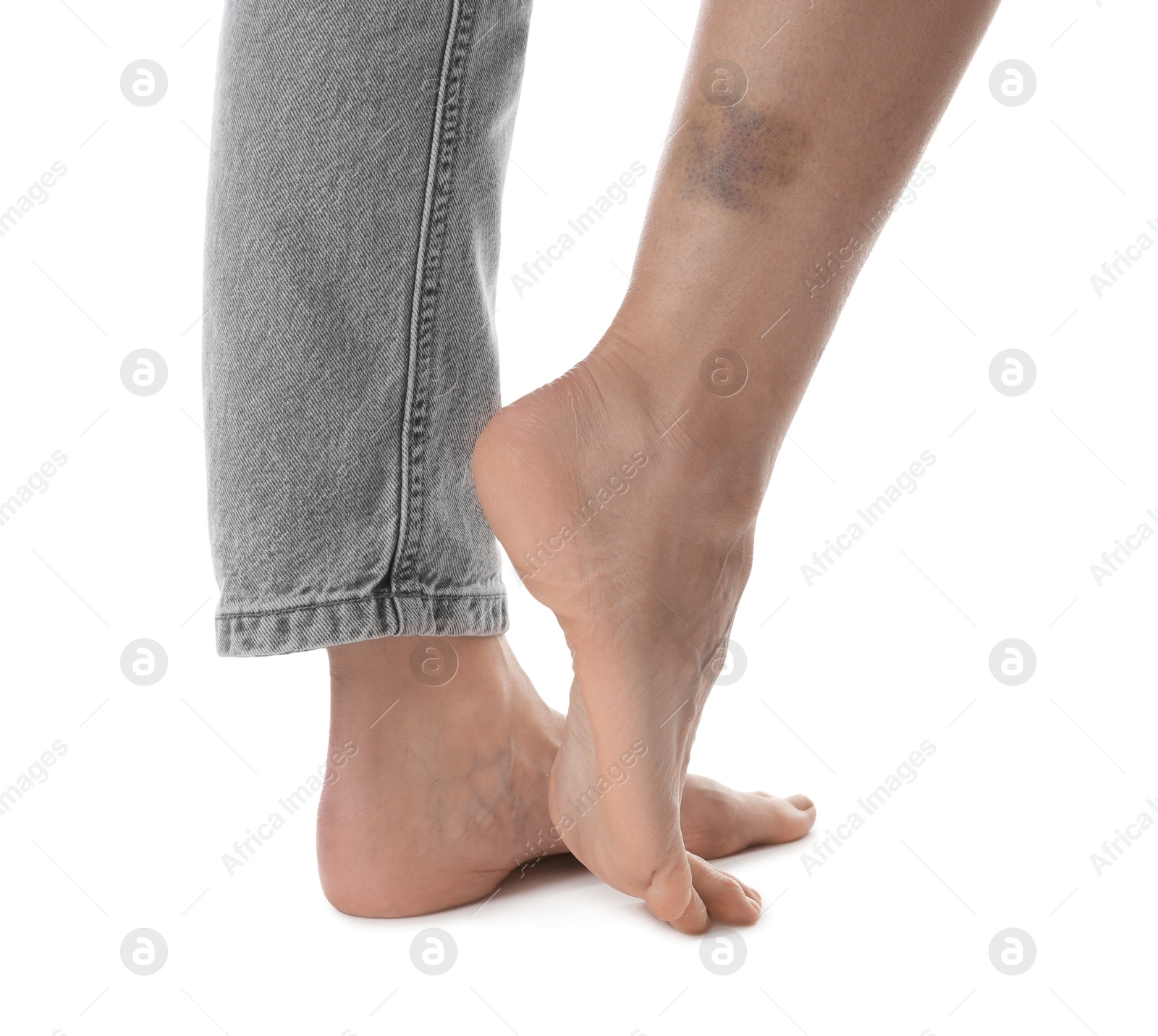 Woman with bruise on leg against white background, closeup Photo of Woman with bruise on leg against white background, closeup