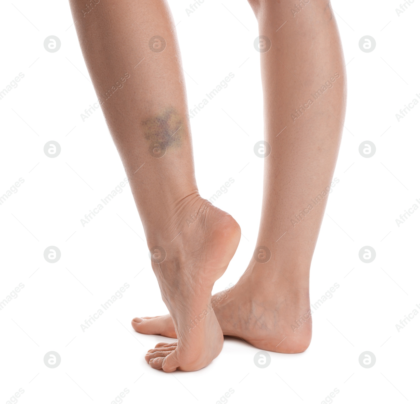Woman with bruise on leg against white background, closeup Photo of Woman with bruise on leg against white background, closeup