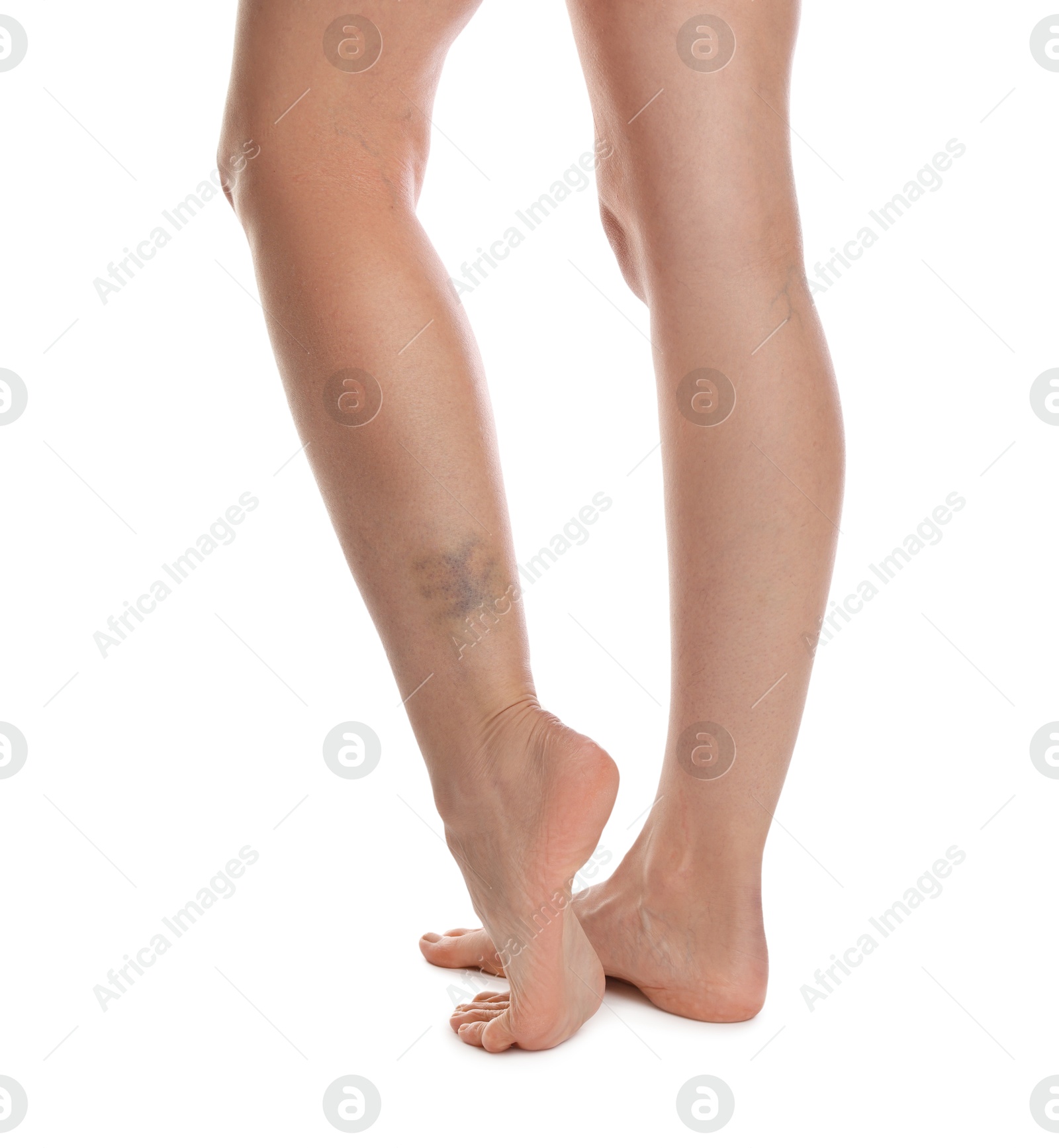 Woman with bruise on leg against white background, closeup Photo of Woman with bruise on leg against white background, closeup