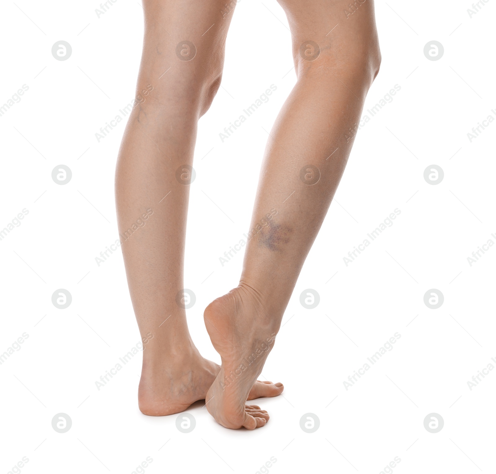 Woman with bruise on leg against white background, closeup Photo of Woman with bruise on leg against white background, closeup