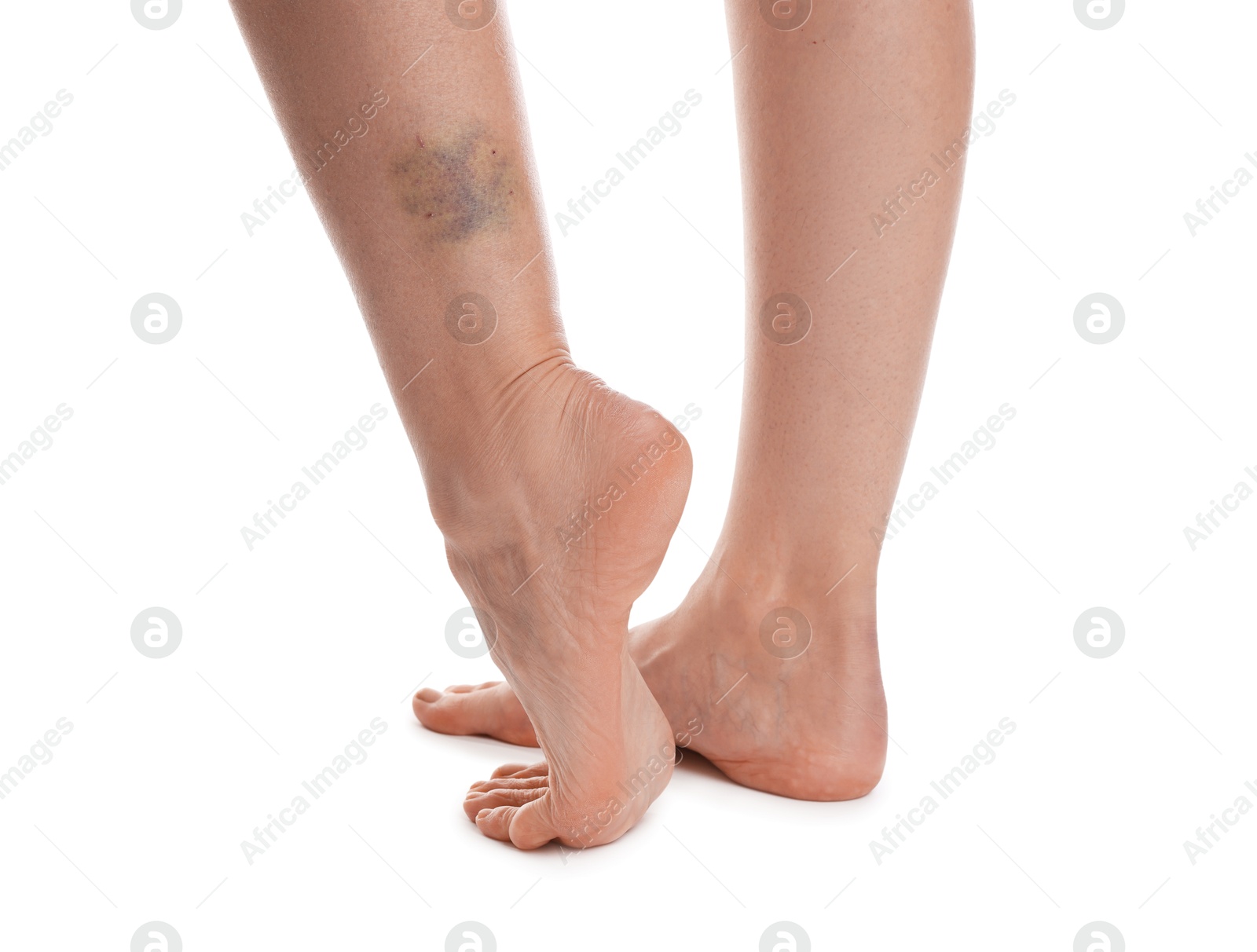 Woman with bruise on leg against white background, closeup Photo of Woman with bruise on leg against white background, closeup