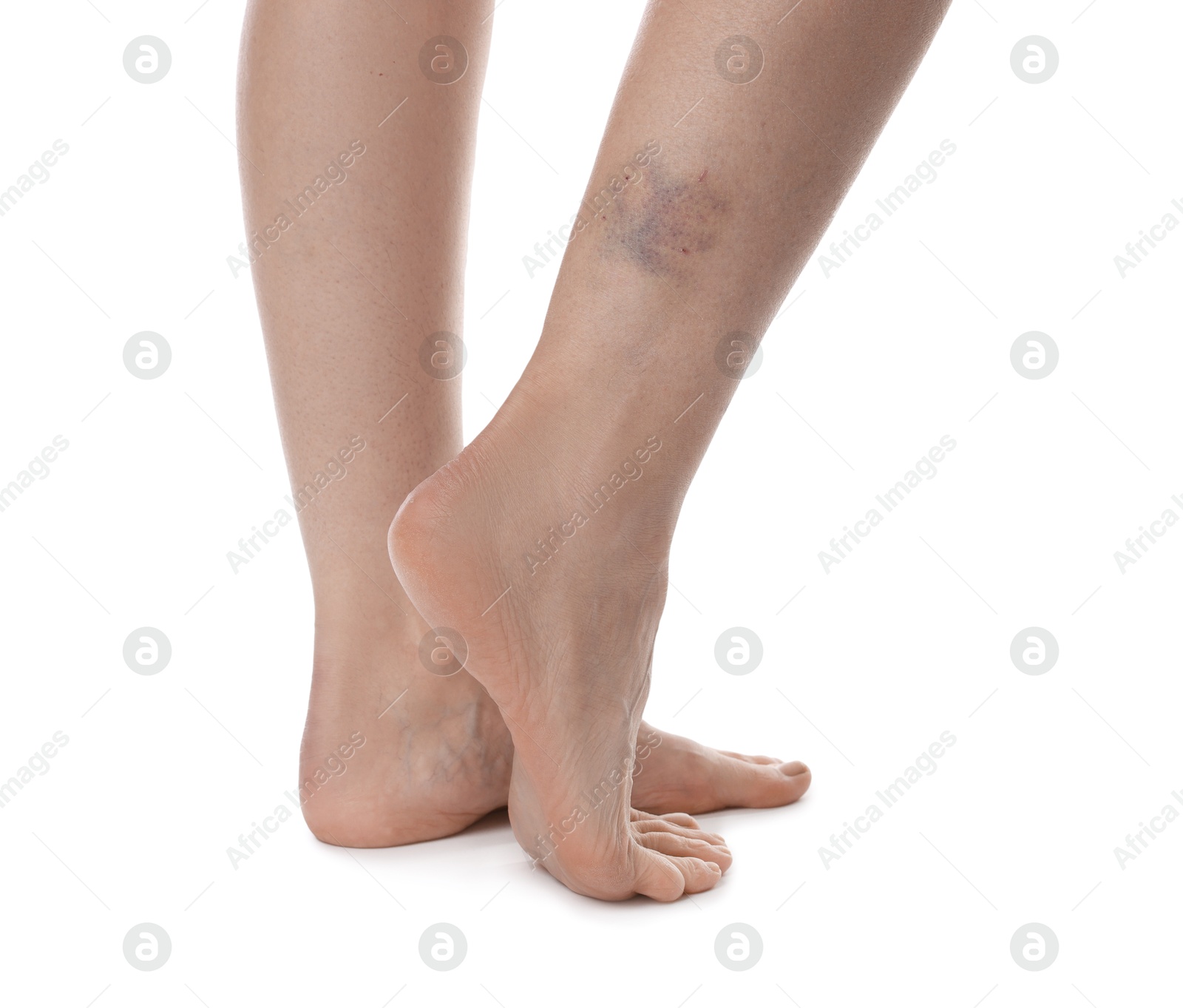 Woman with bruise on leg against white background, closeup Photo of Woman with bruise on leg against white background, closeup