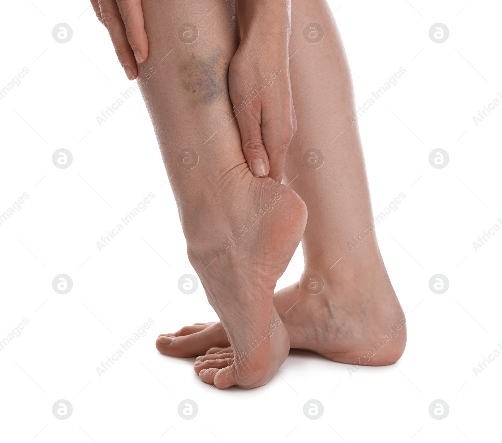 Woman with bruise on leg against white background, closeup Photo of Woman with bruise on leg against white background, closeup