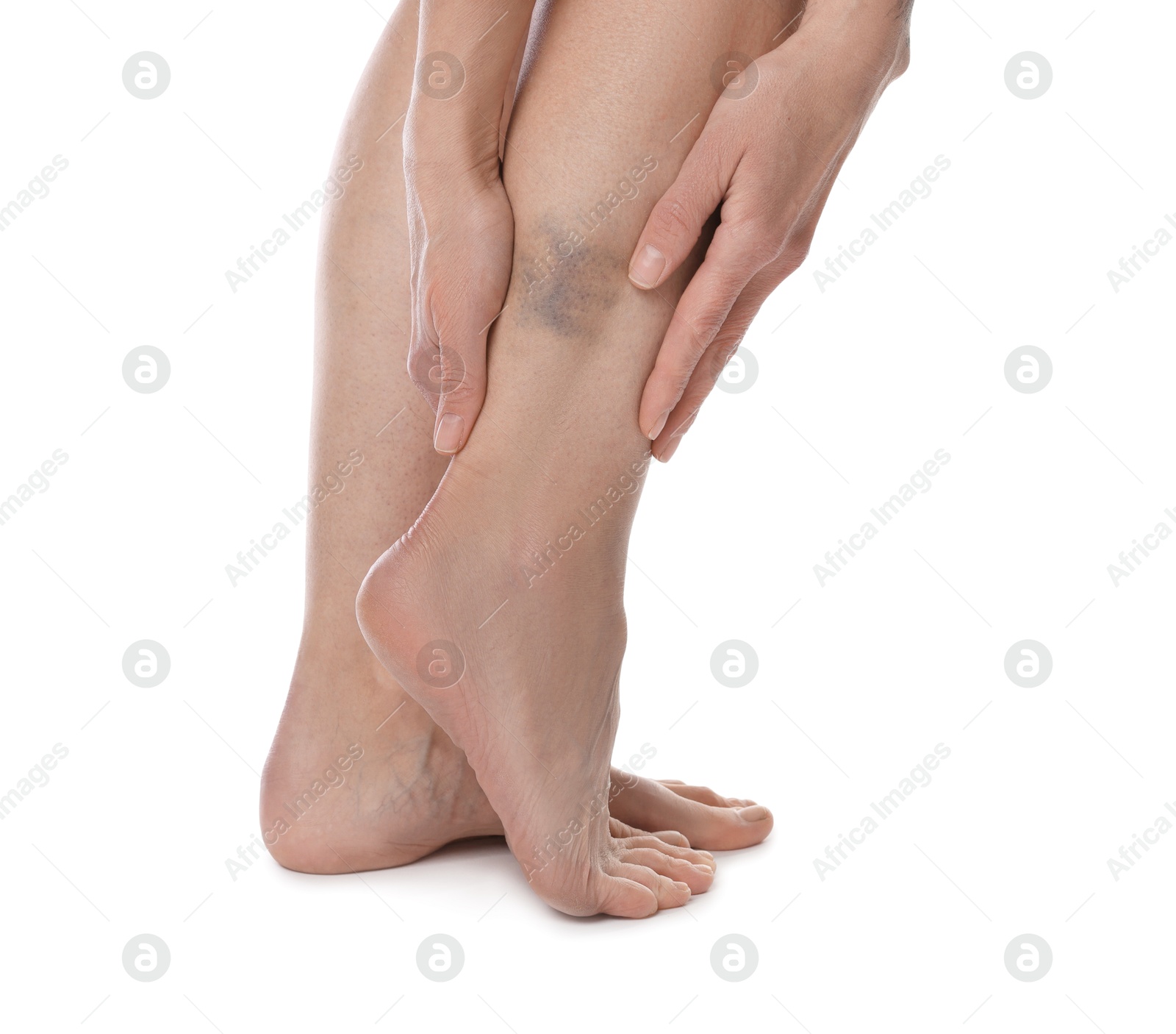 Woman with bruise on leg against white background, closeup Photo of Woman with bruise on leg against white background, closeup