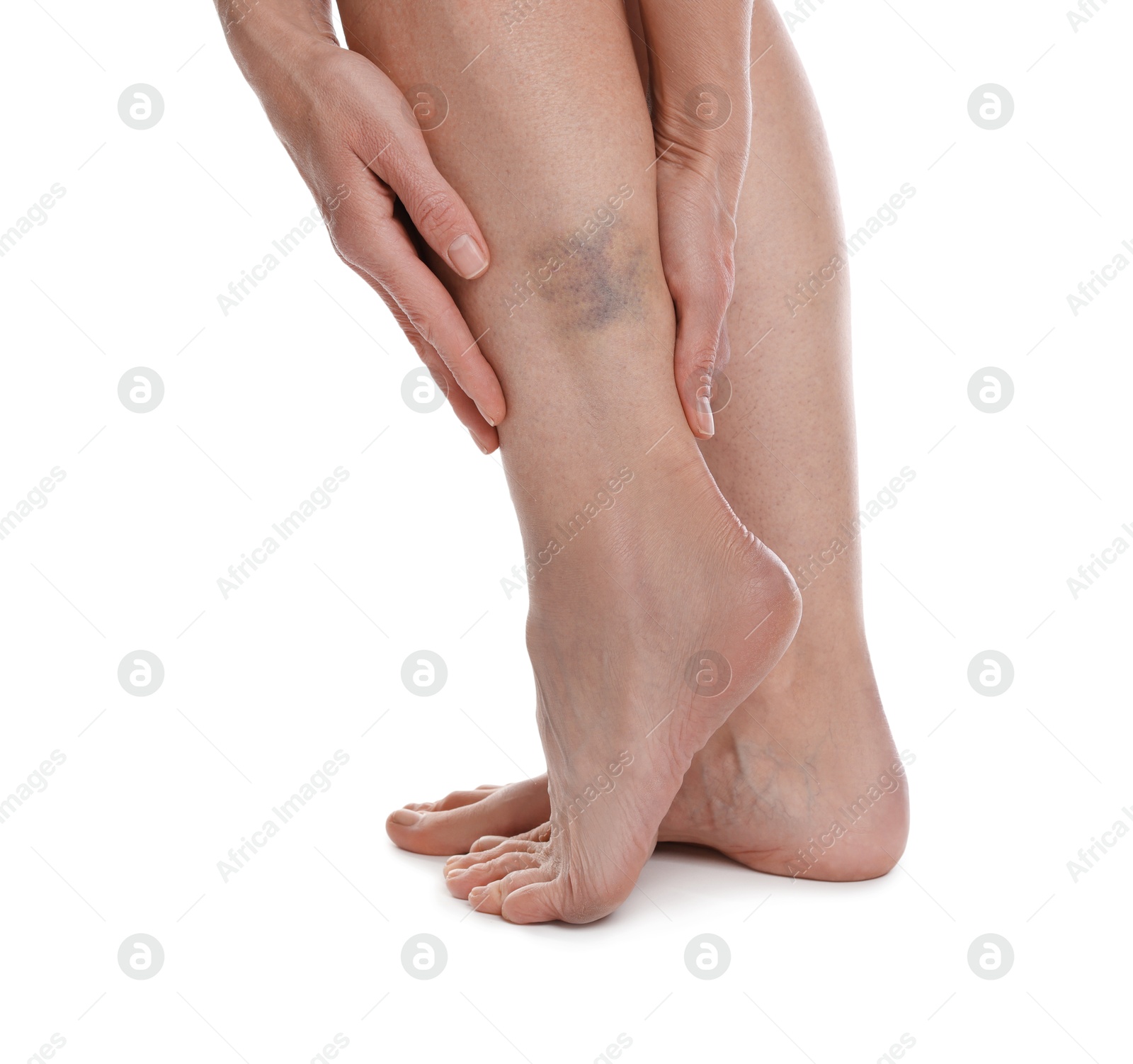 Woman with bruise on leg against white background, closeup Photo of Woman with bruise on leg against white background, closeup