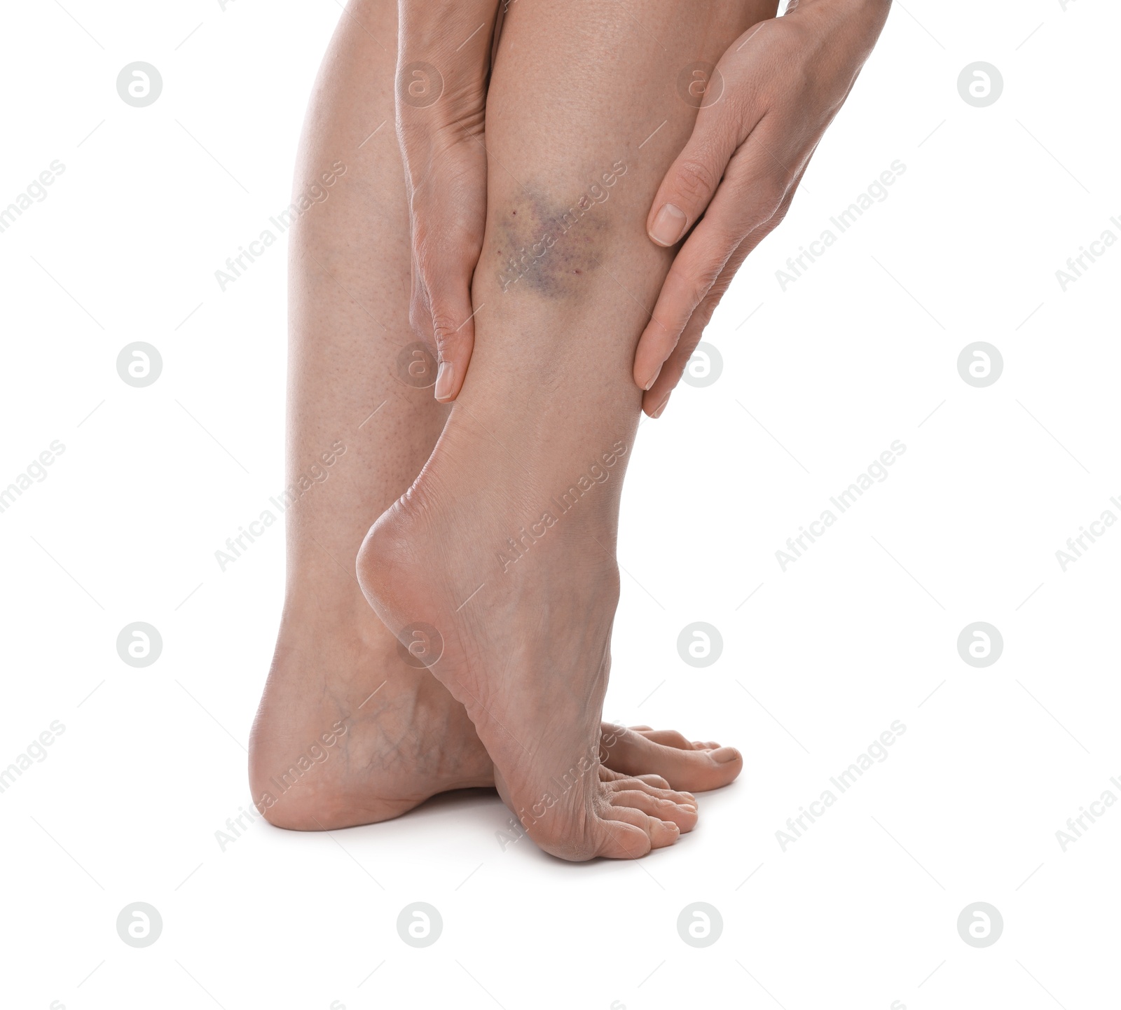 Woman with bruise on leg against white background, closeup Photo of Woman with bruise on leg against white background, closeup