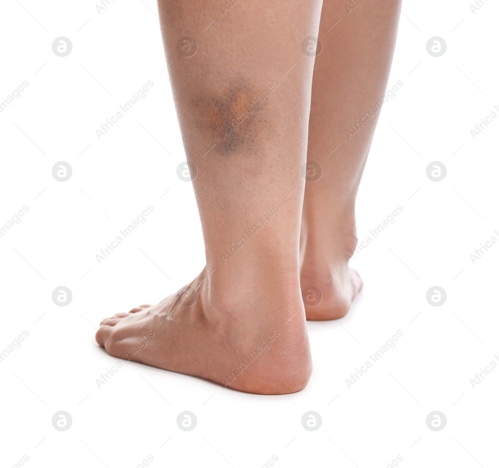 Woman with bruise on leg against white background, closeup Photo of Woman with bruise on leg against white background, closeup