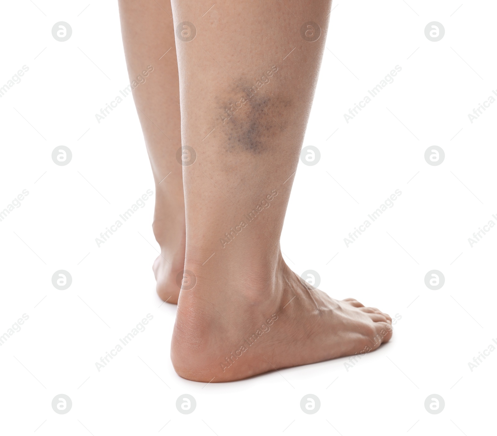 Woman with bruise on leg against white background, closeup Photo of Woman with bruise on leg against white background, closeup