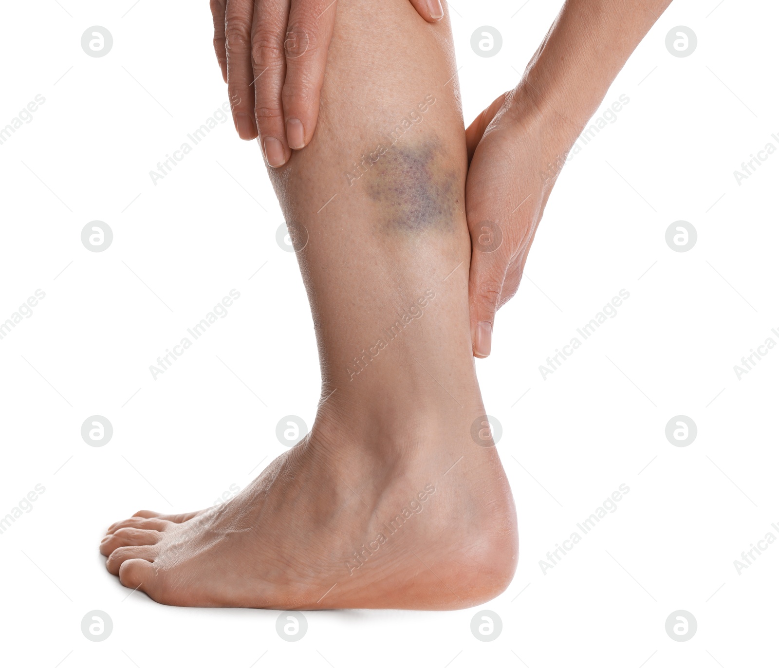 Woman with bruise on leg against white background, closeup Photo of Woman with bruise on leg against white background, closeup