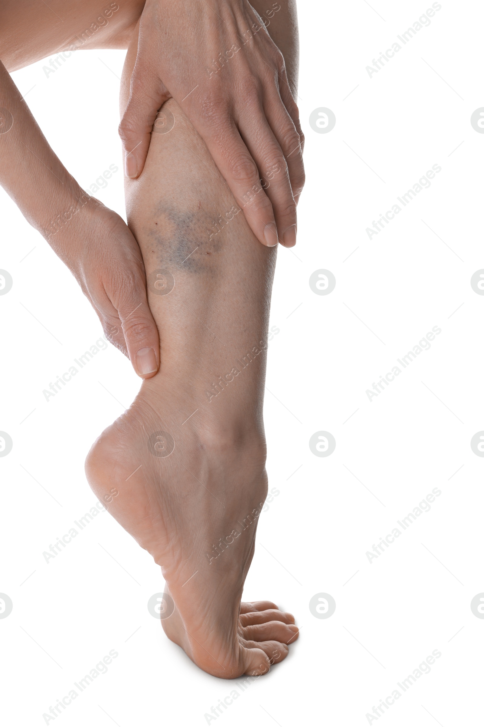 Woman with bruise on leg against white background, closeup Photo of Woman with bruise on leg against white background, closeup