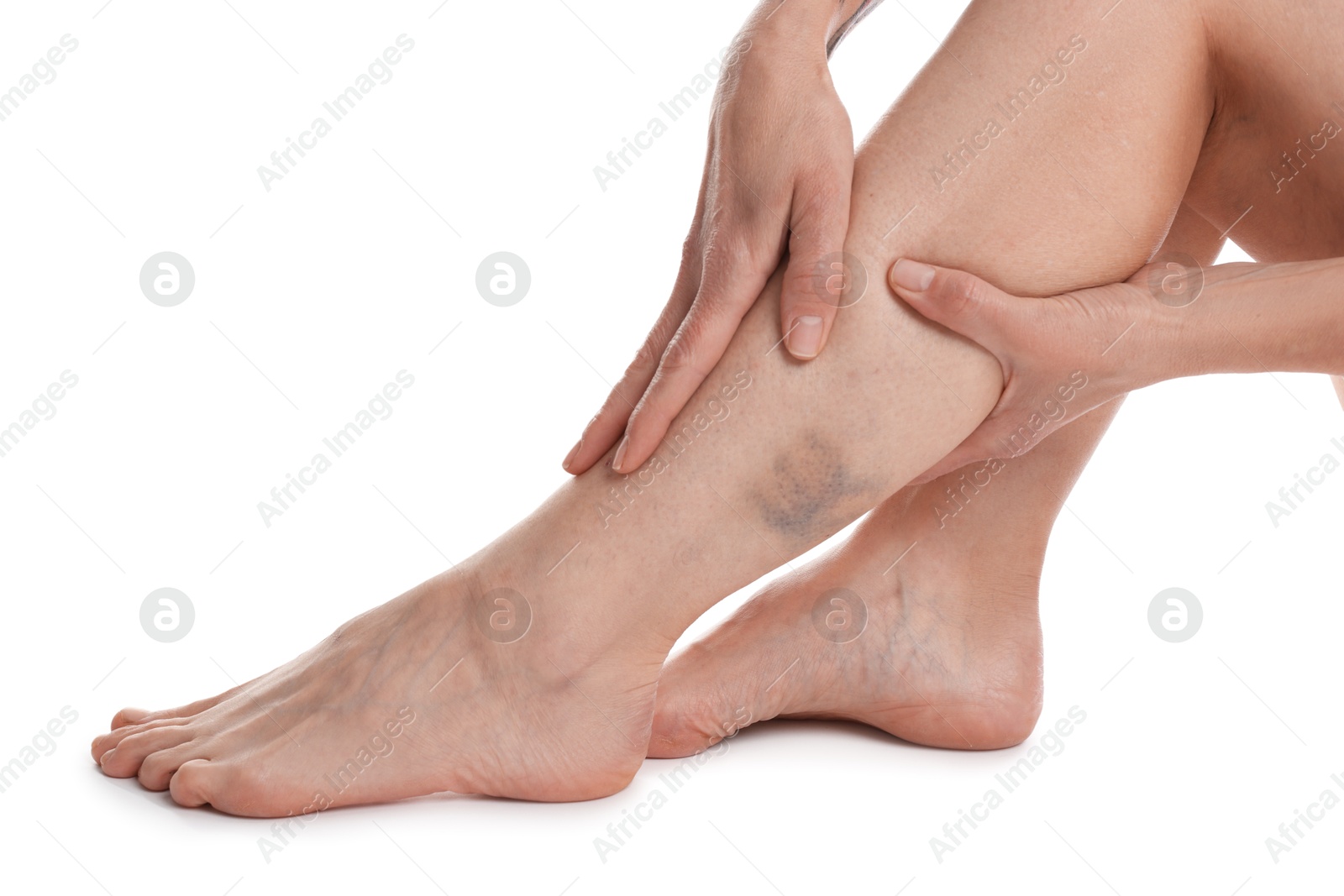 Woman with bruise on leg against white background, closeup Photo of Woman with bruise on leg against white background, closeup