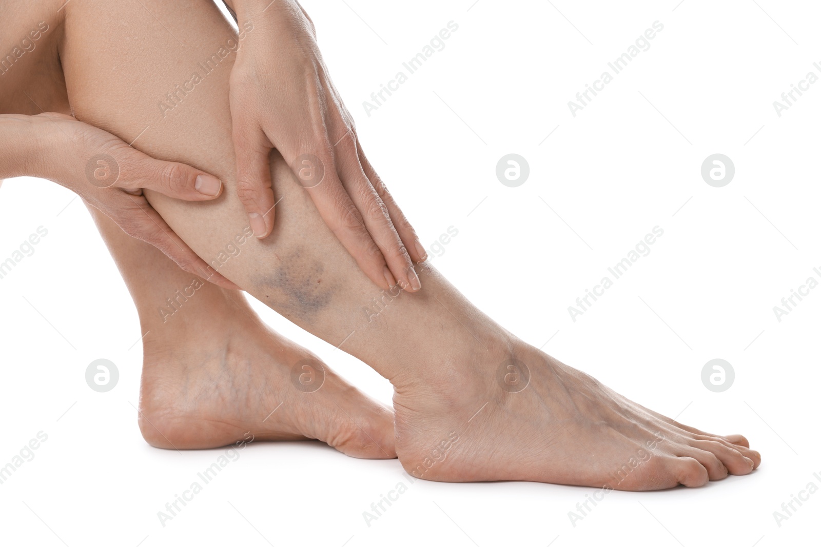 Woman with bruise on leg against white background, closeup Photo of Woman with bruise on leg against white background, closeup