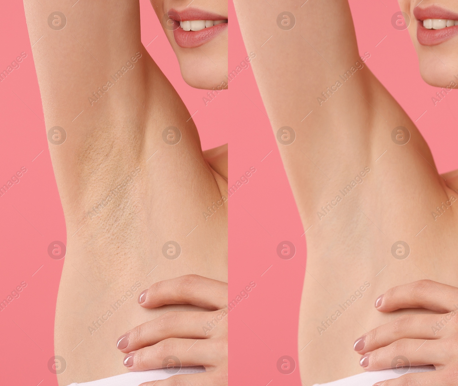 Epilation and depilation. Collage with photos of woman showing armpit after different procedures on pink background, closeup Image of Epilation and depilation. Collage with photos of woman showing armpit after different procedures on pink background, closeup