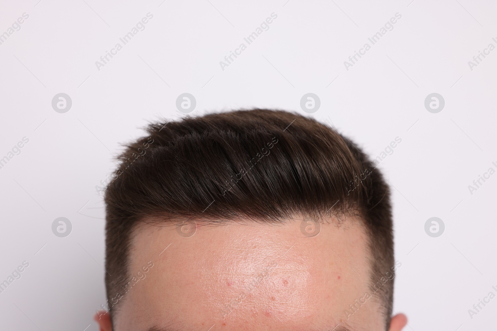 Man after hair loss treatment on light background, closeup Photo of Man after hair loss treatment on light background, closeup