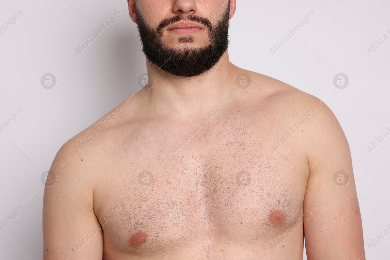 Man before scoliosis treatment on light background, closeup Photo of Man before scoliosis treatment on light background, closeup