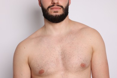 Photo of Man before scoliosis treatment on light background, closeup