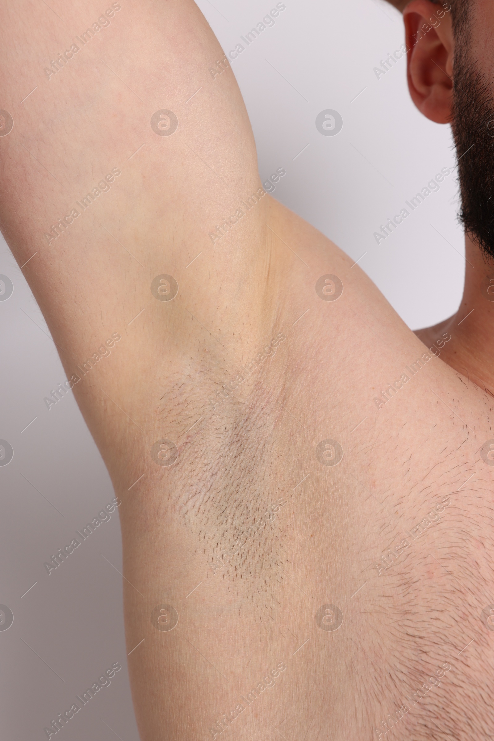 Man after hair removal procedure on light background, closeup Photo of Man after hair removal procedure on light background, closeup