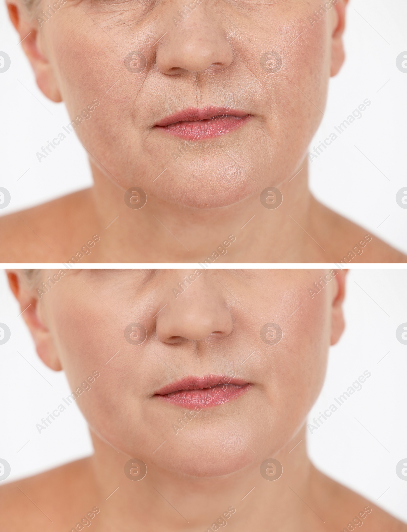 Woman showing face before and after collagen consumption on white background, closeup. Collage of photos comparing skin condition Image of Woman showing face before and after collagen consumption on white background, closeup. Collage of photos comparing skin condition
