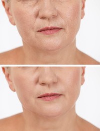 Image of Woman showing face before and after collagen consumption on white background, closeup. Collage of photos comparing skin condition
