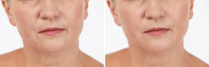 Image of Woman showing face before and after collagen consumption on white background, closeup. Collage of photos comparing skin condition