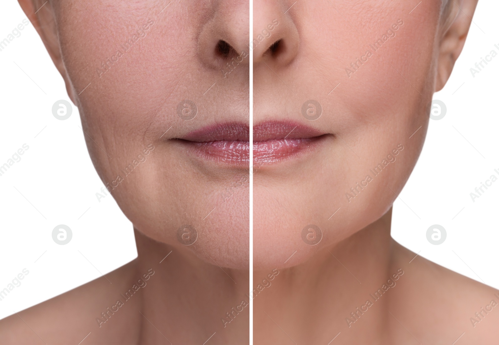 Woman showing face before and after collagen consumption on white background, closeup. Collage of photos comparing skin condition Image of Woman showing face before and after collagen consumption on white background, closeup. Collage of photos comparing skin condition