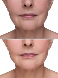 Image of Woman showing face before and after collagen consumption on white background, closeup. Collage of photos comparing skin condition