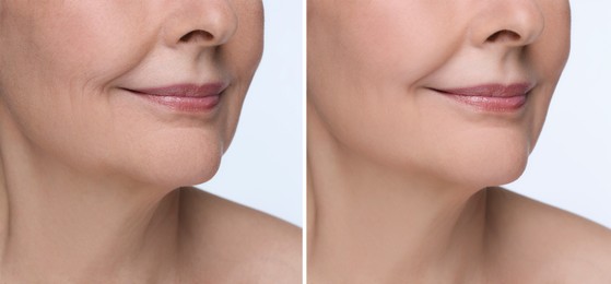 Image of Woman showing face before and after collagen consumption on white background, closeup. Collage of photos comparing skin condition