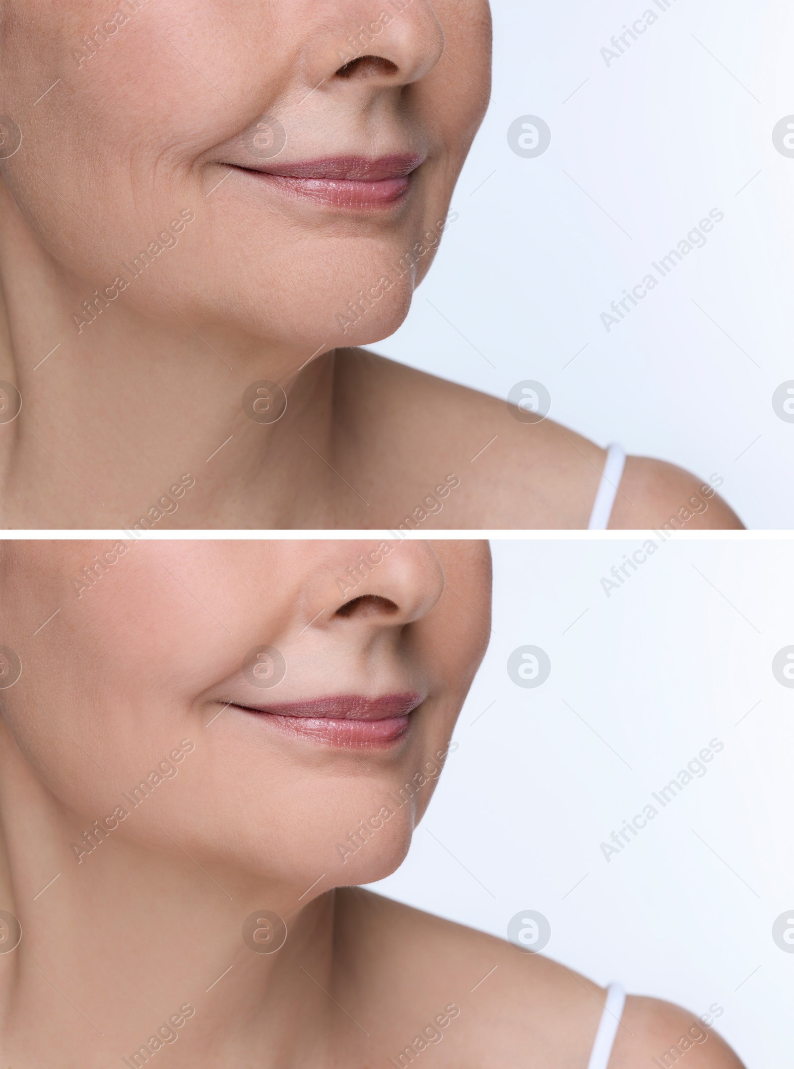 Woman showing face before and after collagen consumption on white background, closeup. Collage of photos comparing skin condition Image of Woman showing face before and after collagen consumption on white background, closeup. Collage of photos comparing skin condition