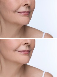 Image of Woman showing face before and after collagen consumption on white background, closeup. Collage of photos comparing skin condition