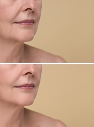 Image of Woman showing face before and after collagen consumption on beige background, closeup. Collage of photos comparing skin condition