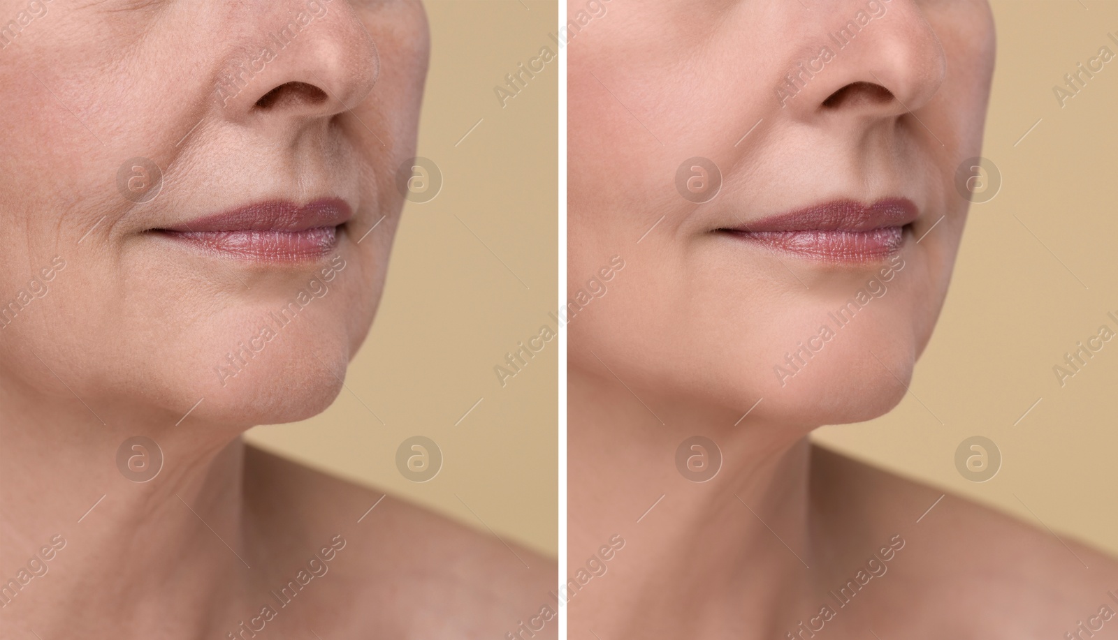Woman showing face before and after collagen consumption on beige background, closeup. Collage of photos comparing skin condition Image of Woman showing face before and after collagen consumption on beige background, closeup. Collage of photos comparing skin condition