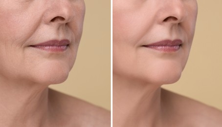 Image of Woman showing face before and after collagen consumption on beige background, closeup. Collage of photos comparing skin condition