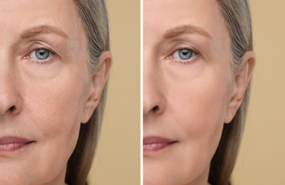 Image of Senior woman showing face before and after collagen consumption on beige background, closeup. Collage of photos comparing skin condition