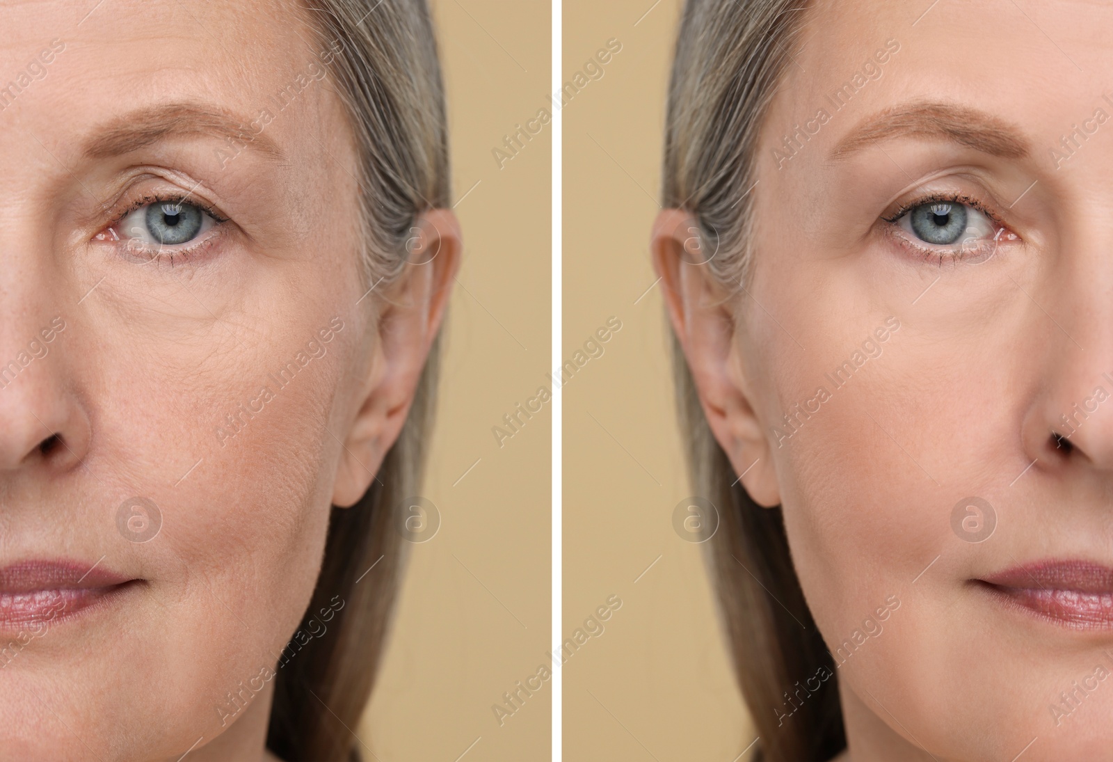 Senior woman showing face before and after collagen consumption on beige background, closeup. Collage of photos comparing skin condition Image of Senior woman showing face before and after collagen consumption on beige background, closeup. Collage of photos comparing skin condition