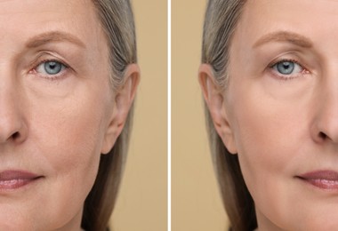 Image of Senior woman showing face before and after collagen consumption on beige background, closeup. Collage of photos comparing skin condition