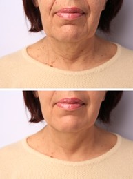 Image of Senior woman showing face before and after collagen consumption on white background, closeup. Collage of photos comparing skin condition