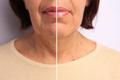 Image of Senior woman showing face before and after collagen consumption on white background, closeup. Collage of photos comparing skin condition
